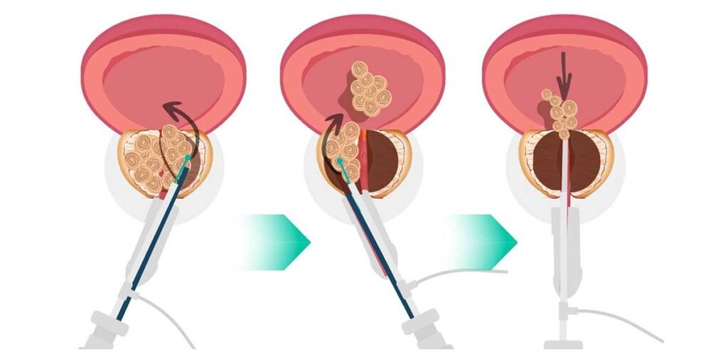 Enucleacion Prostatica con Laser La Innovacion en el Tratamiento de la Hiperplasia Benigna de Prostata